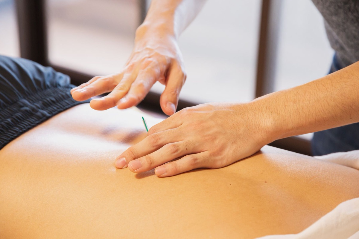Practitioner performing dry needling on a patient's back